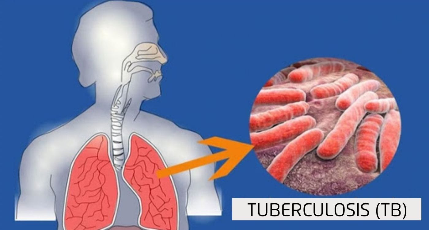 Tuberculosis (TB)